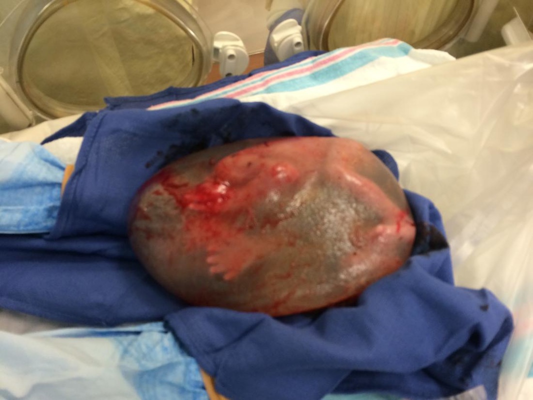 How Does Amniotic Sac Help The Baby Develop Lungs